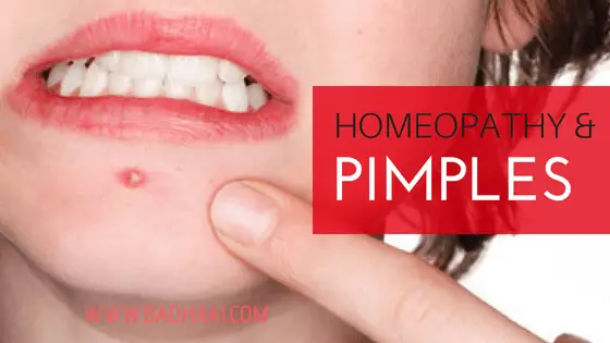 Homeopathic Remedies For Acne And Pimples Homeopathic Remedies For Acne And Pimples